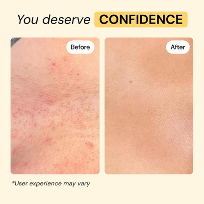 Universal Flare Care – Multi-Purpose Solution | Skin Flare-Ups - Hidradenitis Suppurativa, Folliculitis - photo 5