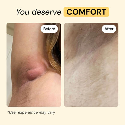 Universal Flare Care – Multi-Purpose Solution | Skin Flare-Ups - Hidradenitis Suppurativa, Folliculitis - photo 4