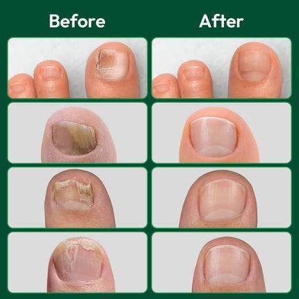 VERDORA Renewal Fungal Nail Patches, 16 Pcs Fungus Treatment Extra Strength Overnight Nail Care, 8-Hour Moisturizing & Nourishing, for Healthy Appearance, Men & Women