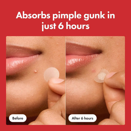 Hydrocolloid Acne Patches - application