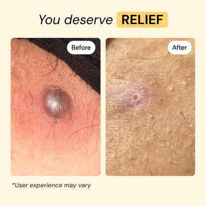 Universal Flare Care – Multi-Purpose Solution | Skin Flare-Ups - Hidradenitis Suppurativa, Folliculitis - photo 3