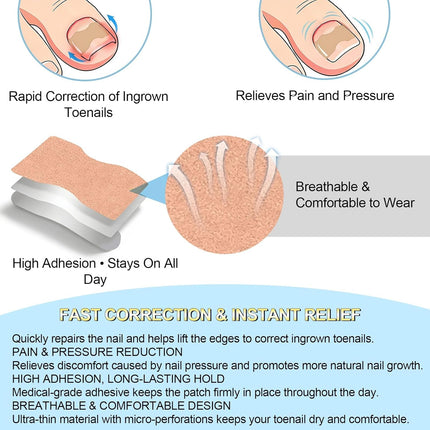 Ingrown toenail treatment，Breathable toenail correction patch, 50-piece package, can quickly repair toenails, using high-viscosity-grade glue, not easy to fall off, and easily solve toenail problems.