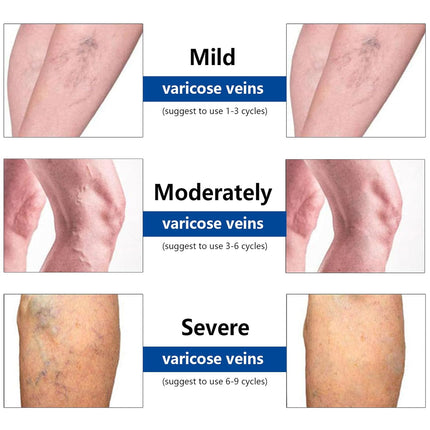 VeinTarget Microdarts Patch, Professional Varicose Veins Treatment for Legs, Gfuel Vein Target Patch, Natural Ingredients Leg Treatment for All Skin Types (1 Pack)