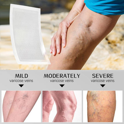 VeinTarget Microdarts Patch, Professional Varicose Veins Treatment for Legs, Gfuel Vein Target Patch, Natural Ingredients Leg Treatment for All Skin Types (1 Pack)