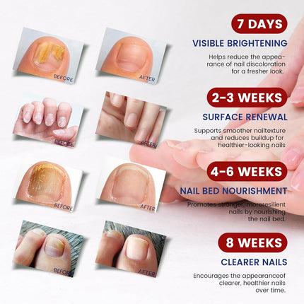 Toenail Fungus Treatment Extra Strength - 21 Pcs Fungal Nail Patches, 8-Hour Firm Adhesion, Nail Repair for Damaged Nails, Overnight Renewal for Men & Women (1 Count (Pack of 21))