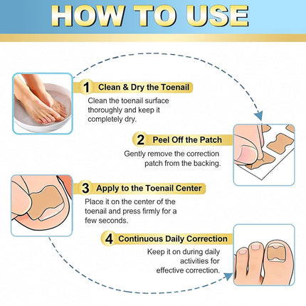 Ingrown toenail treatment，Breathable toenail correction patch, 50-piece package, can quickly repair toenails, using high-viscosity-grade glue, not easy to fall off, and easily solve toenail problems.