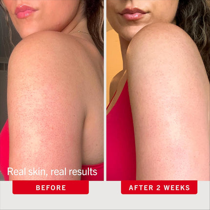 First Aid Beauty KP Bump Eraser Body Scrub Peach Scent, 10% AHA Keratosis Pilaris Exfoliator (Glycolic & Lactic Acid) Treatment for Strawberry Legs, Razor Bumps & Rough Bumpy Skin